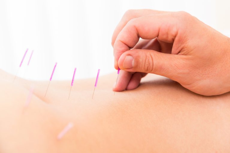 acupuncture_for_back_pain_nyc_dylan_stein